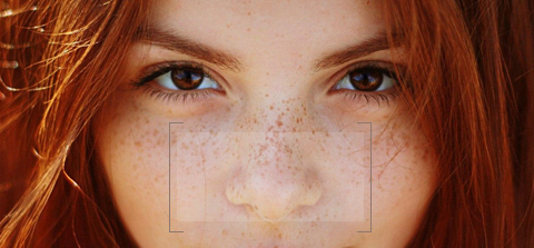 Freckles Treatment dewderm dubai