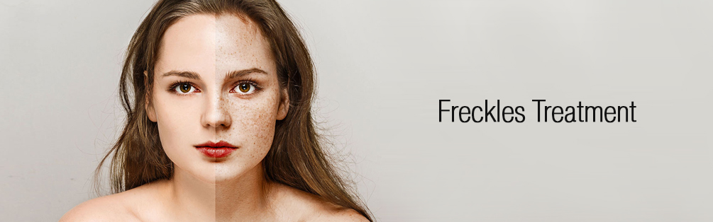 Freckles Treatment dubai