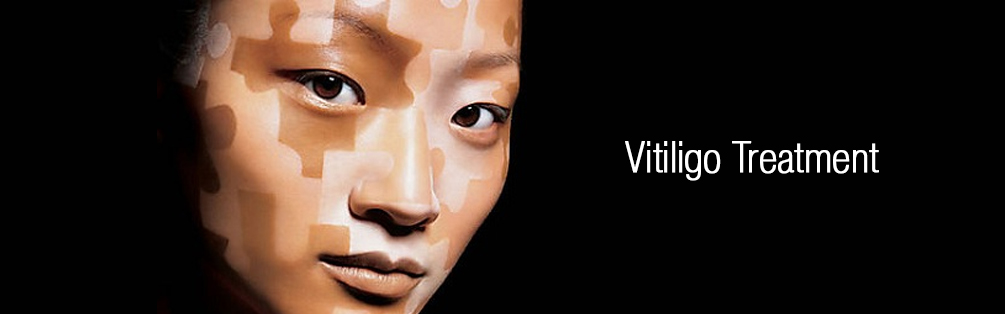 Vitiligo Treatment Dewderm dubai