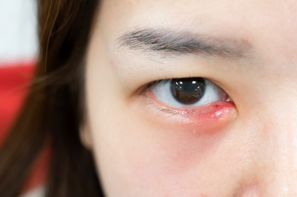 شَعيرَة العين  Stye وعلاجها في المركز الاسباني بدبي 